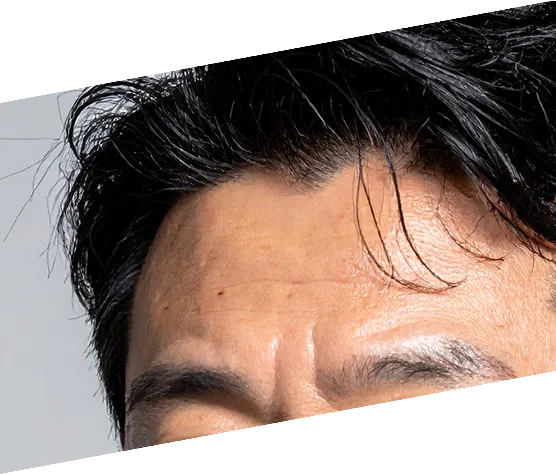 眉間・おでこ