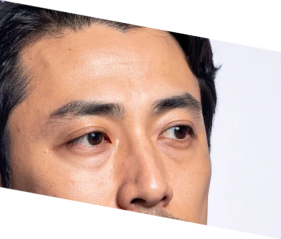 目の下のクマ・たるみ