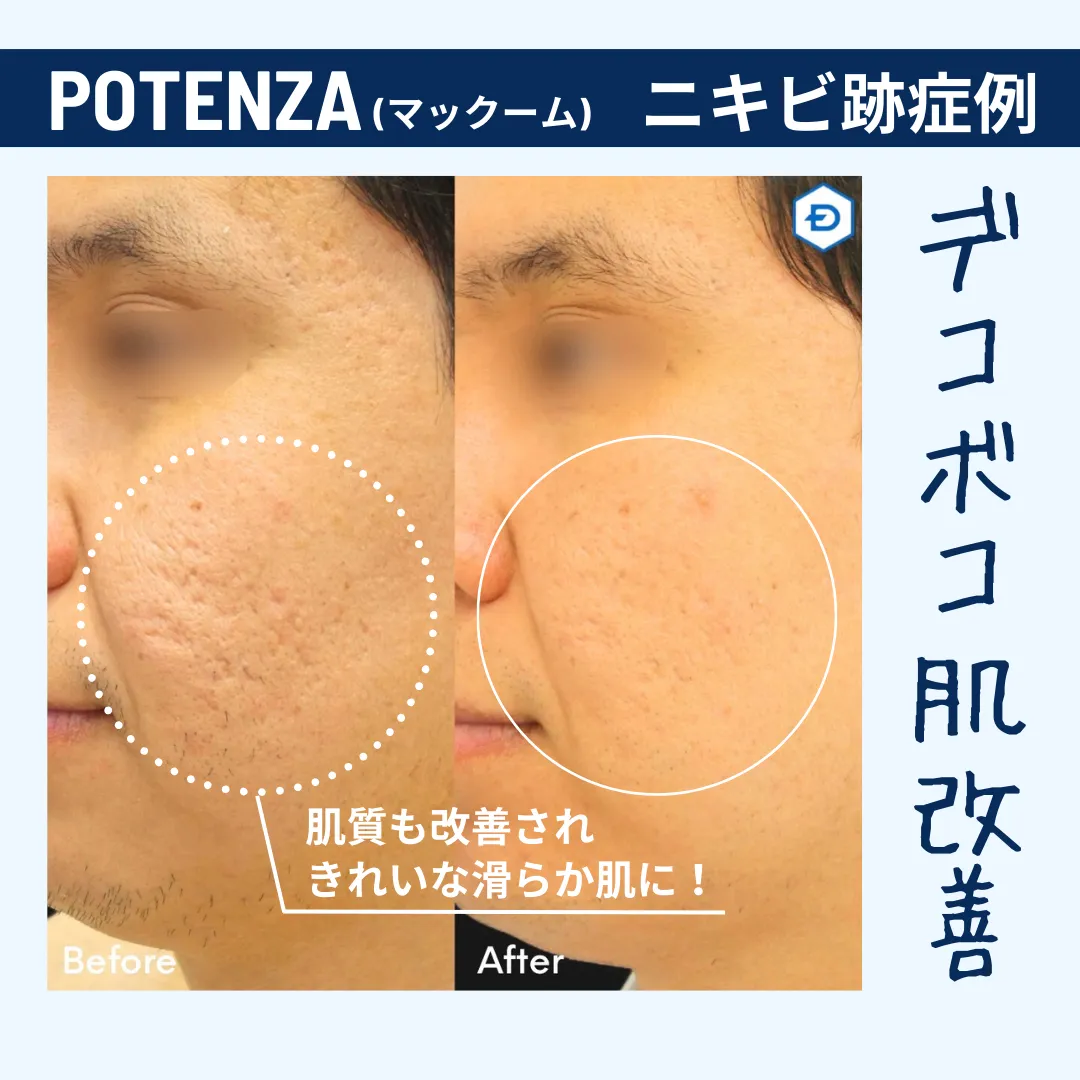 2月限定でお得な限定トライアル　凸凹肌＆お顔のたるみ改善！　POTENZA（ポテンツァ）