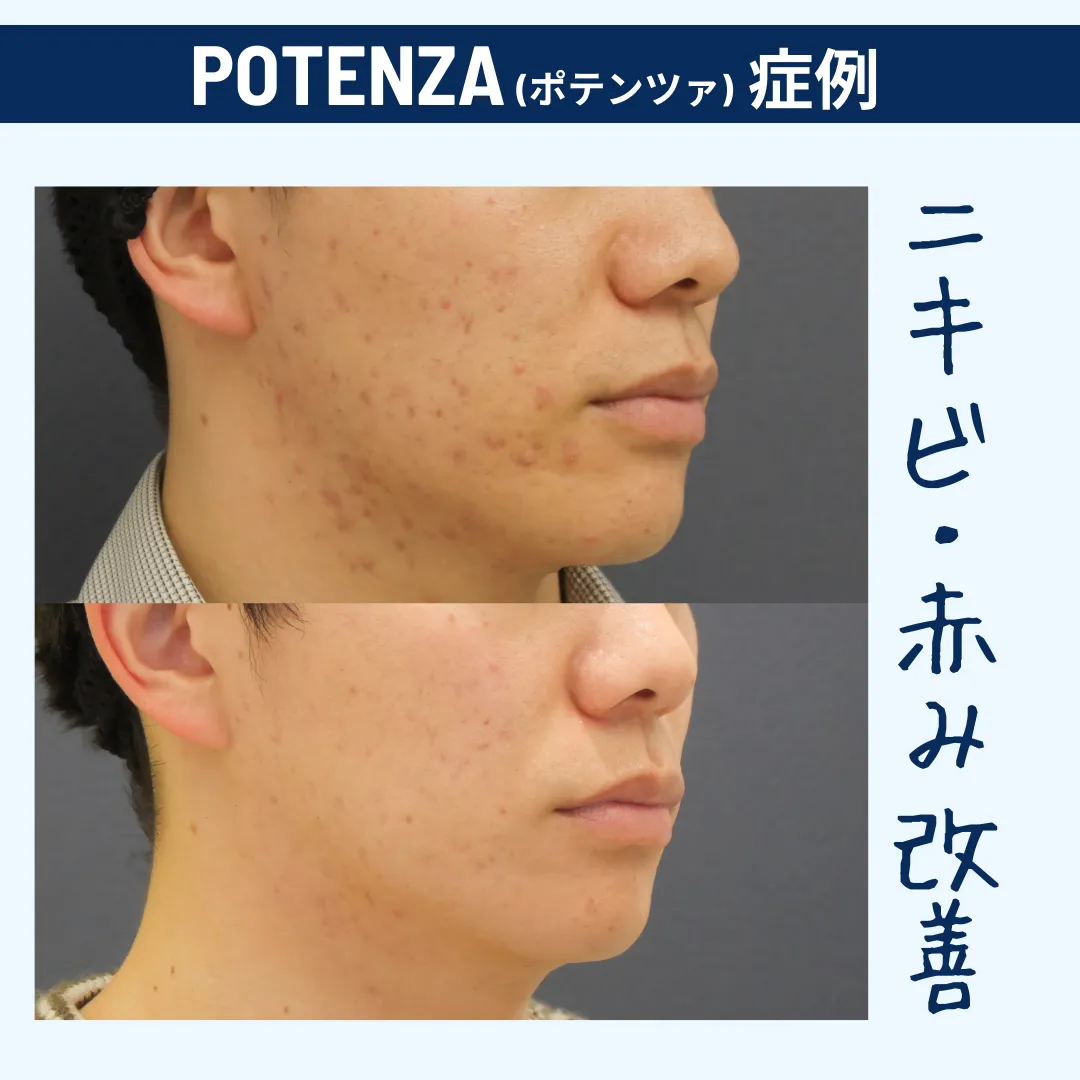 男性の肌悩み　赤み・ニキビ・クレーターにはこれ1台で解消！　POTENZA　ポテンツァ