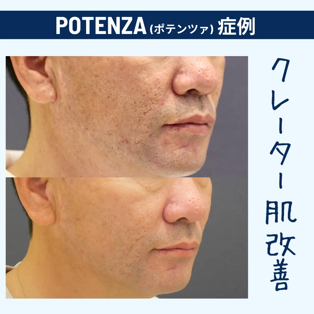 男性の肌悩み　赤み・ニキビ・クレーターにはこれ1台で解消！　POTENZA　ポテンツァ