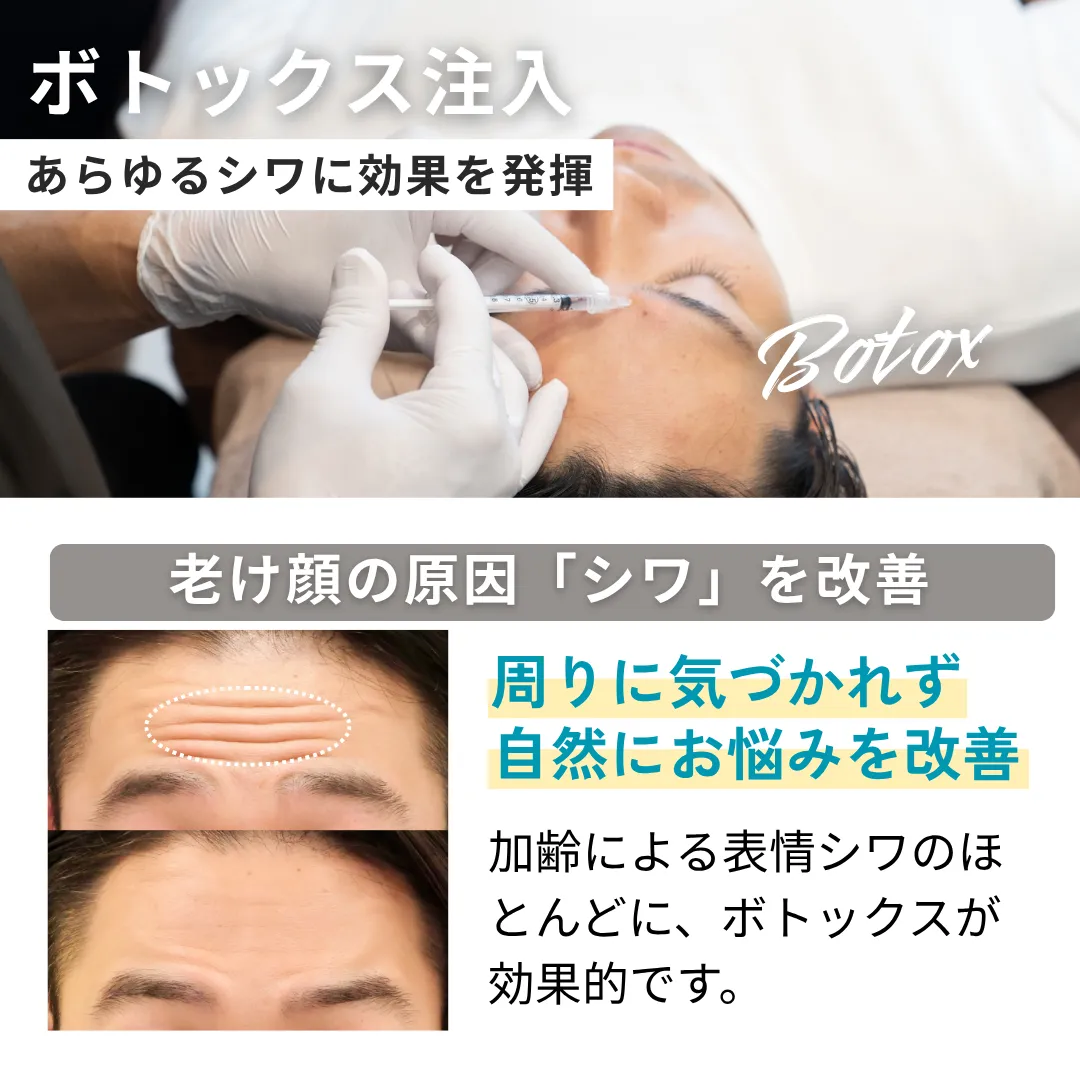 ボトックス注入キャンペーン