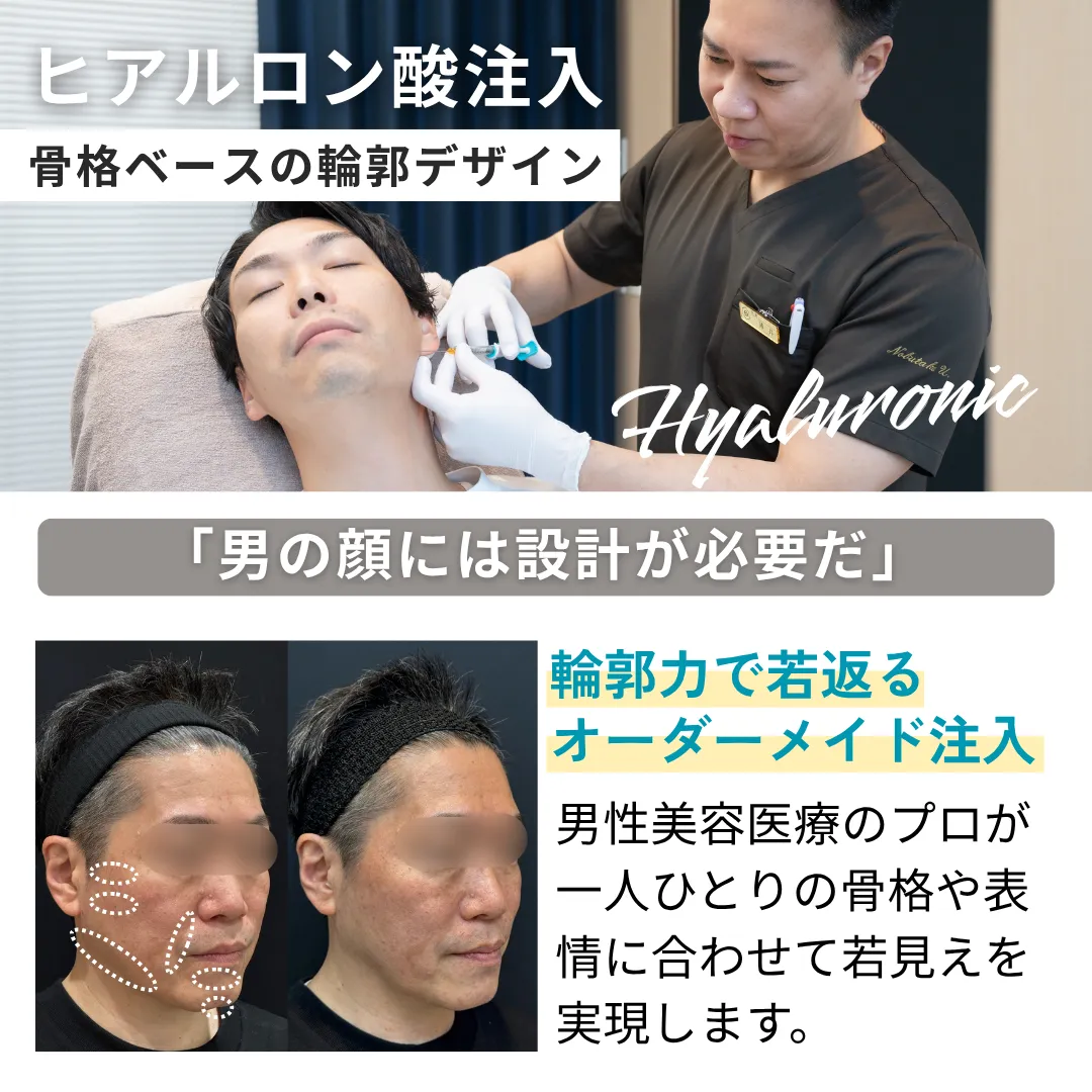 ヒアルロン酸注射　症例モニターキャンペーン